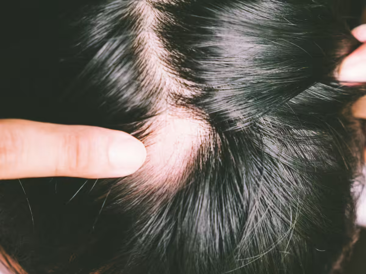 ​​Try home remedies​